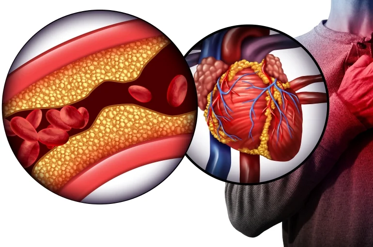 علت اصلی سکته قلبی